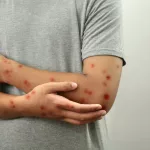 El brote de sarampión en Canarias se extiende: ya son 21 los casos confirmados en La Palma y Gran Canaria