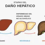 Hígado graso: cuál es la dieta más eficaz para tratarlo, según un especialista