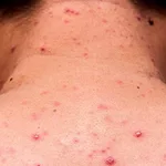 El país de América que perdió el estatus de libre de sarampión y cómo afecta a la Argentina y al resto de la región