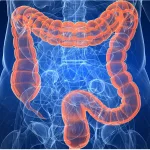 Cáncer colorrectal: identifican un síntoma que no debe ignorarse para detectar la enfermedad