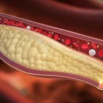 Publicaron las nuevas guías con los valores de colesterol recomendados para prevenir infartos y ACV