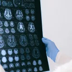 Exitosa prueba en humanos para evitar el Alzheimer con un método que fortalece el sistema inmune del cerebro