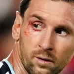 Messi y un sorprendente sangrado en su ojo durante el Argentina-Suiza