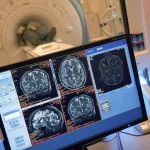 Encuentran una secuela cerebral más persistente de lo que se creía en ex rugbiers y boxeadores retirados