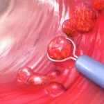 Estudian por 13 años casos de cáncer de colon y ponen en duda que la colonoscopia sirva para evitar muertes