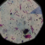 Preocupa una bacteria cuyo contagio no para de crecer y causa una muerte cada siete horas pese a tener cura